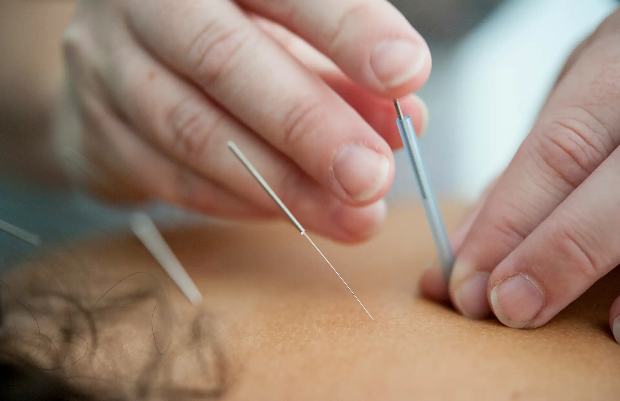 Dry needling et aiguille sèche · cabinet KSP La Valette-du-Var